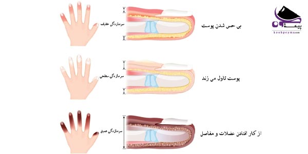 علائم سرمازدگی