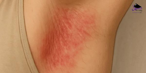 عرق سوز شدن زیر بغل