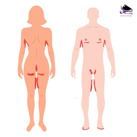 نواحی ساییدگی پوست در بدن